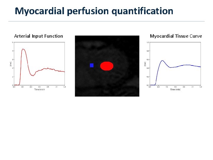 Myocardial perfusion quantification Arterial Input Function Myocardial Tissue Curve 