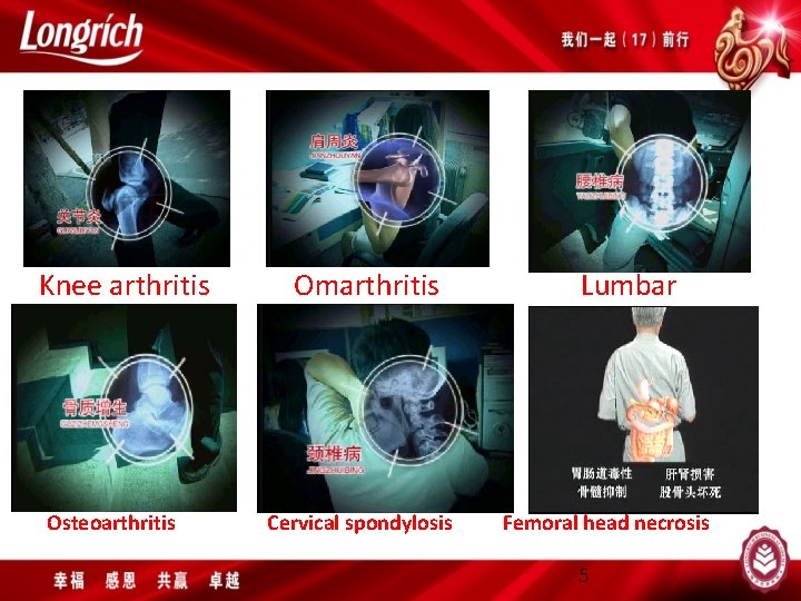 Knee arthritis Osteoarthritis Omarthritis Cervical spondylosis Lumbar Femoral head necrosis 5 