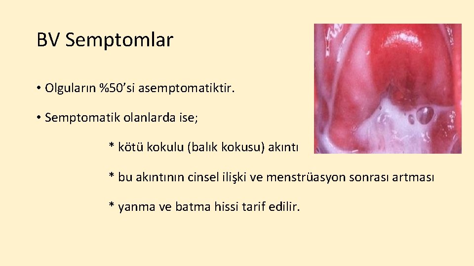 BV Semptomlar • Olguların %50’si asemptomatiktir. • Semptomatik olanlarda ise; * kötü kokulu (balık