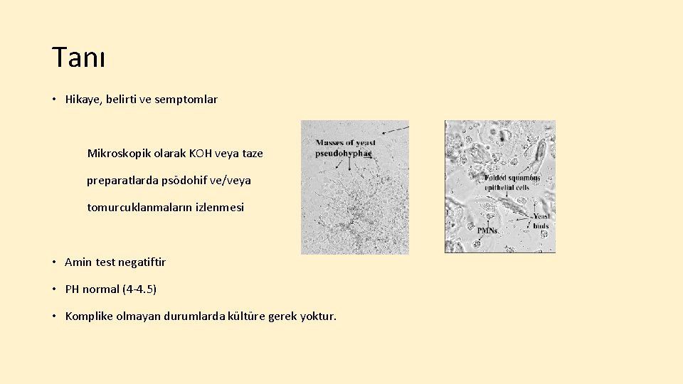 Tanı • Hikaye, belirti ve semptomlar Mikroskopik olarak KOH veya taze preparatlarda psödohif ve/veya