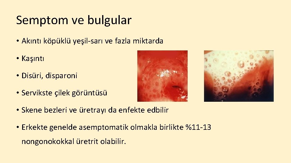 Semptom ve bulgular • Akıntı köpüklü yeşil-sarı ve fazla miktarda • Kaşıntı • Disüri,