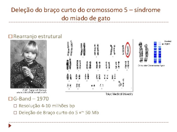 Deleção do braço curto do cromossomo 5 – síndrome do miado de gato �