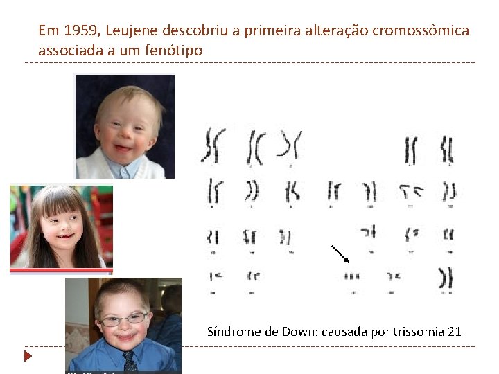 Em 1959, Leujene descobriu a primeira alteração cromossômica associada a um fenótipo Síndrome de