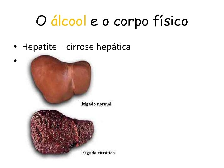 O álcool e o corpo físico • Hepatite – cirrose hepática • 