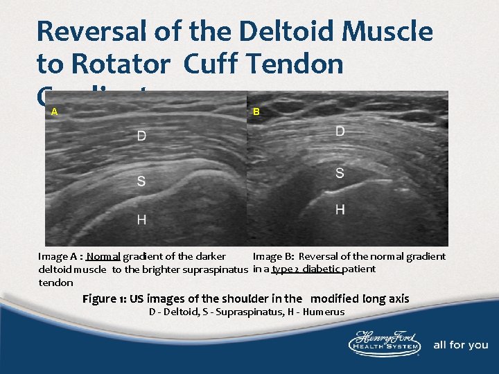 Reversal of the Deltoid Muscle to Rotator Cuff Tendon Gradient A B Image A