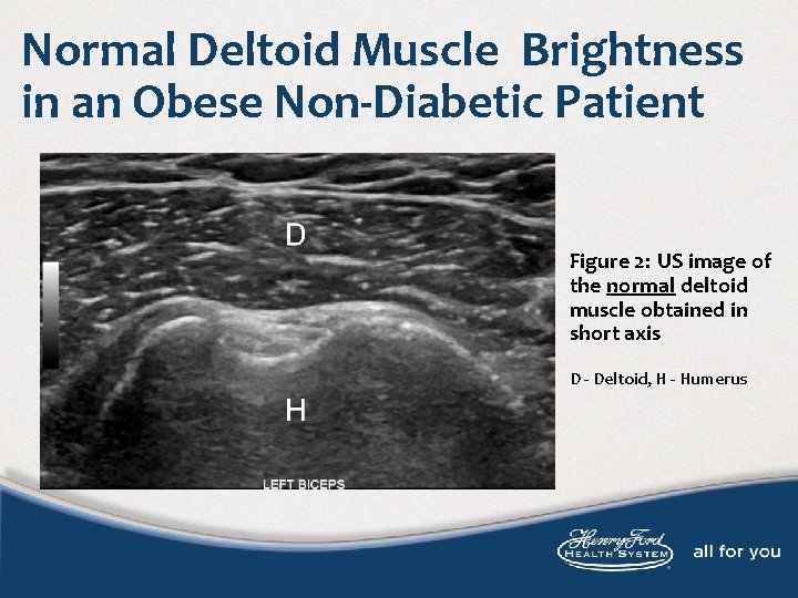 Normal Deltoid Muscle Brightness in an Obese Non-Diabetic Patient Figure 2: US image of