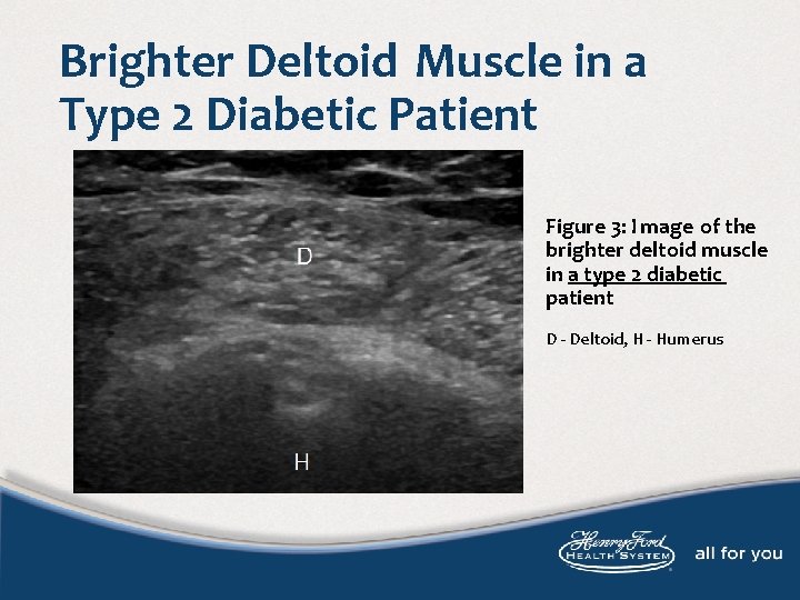 Brighter Deltoid Muscle in a Type 2 Diabetic Patient Figure 3: I mage of