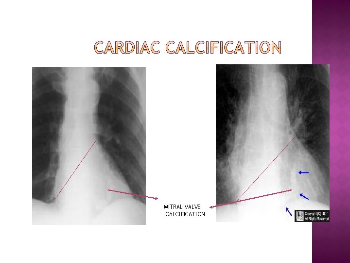 MITRAL VALVE CALCIFICATION 
