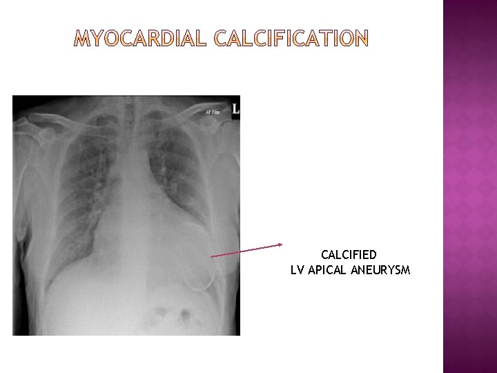 CALCIFIED LV APICAL ANEURYSM 