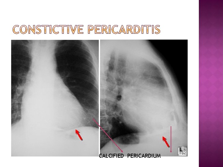 CALCIFIED PERICARDIUM 