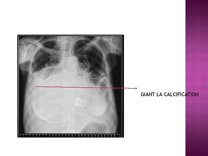 GIANT LA CALCIFICATION 