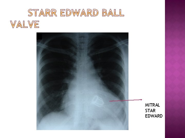 MITRAL STAR EDWARD 