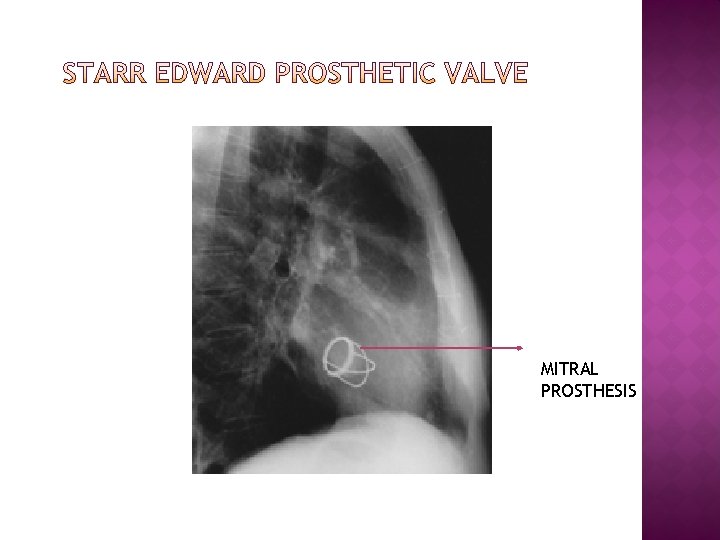 MITRAL PROSTHESIS 
