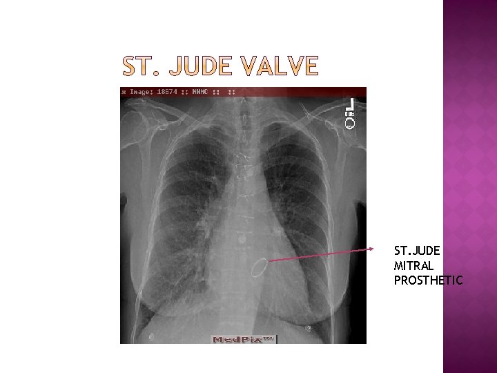 ST. JUDE MITRAL PROSTHETIC 