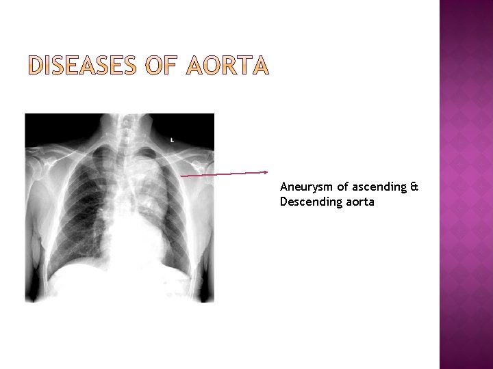 Aneurysm of ascending & Descending aorta 