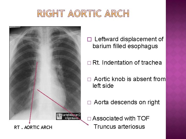 � Leftward displacement of barium filled esophagus � Rt. � � Indentation of trachea