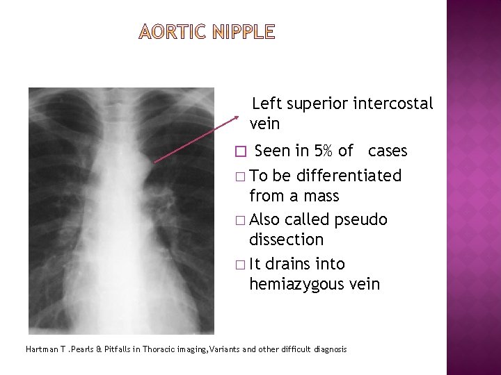 Left superior intercostal vein � Seen in 5% of cases � To be differentiated