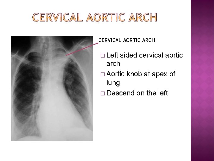 CERVICAL AORTIC ARCH � Left sided cervical aortic arch � Aortic knob at apex