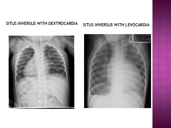 SITUS INVERSUS WITH DEXTROCARDIA SITUS INVERSUS WITH LEVOCARDIA 