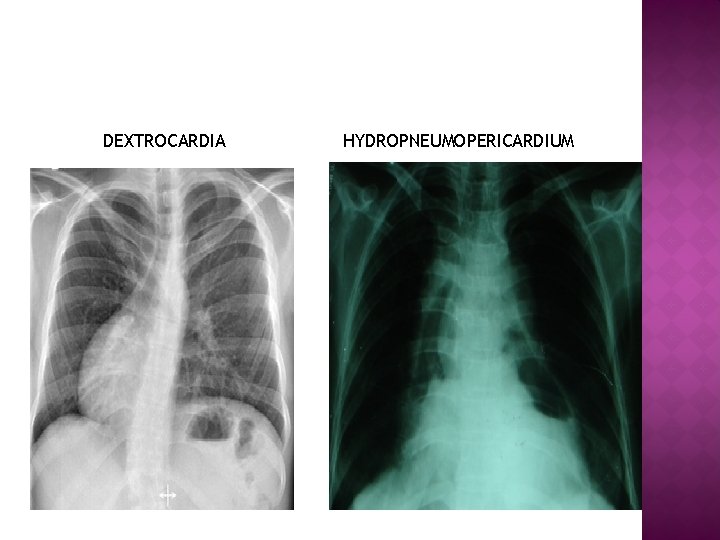 DEXTROCARDIA HYDROPNEUMOPERICARDIUM 