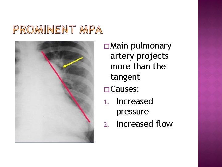 � Main pulmonary artery projects more than the tangent � Causes: 1. Increased pressure