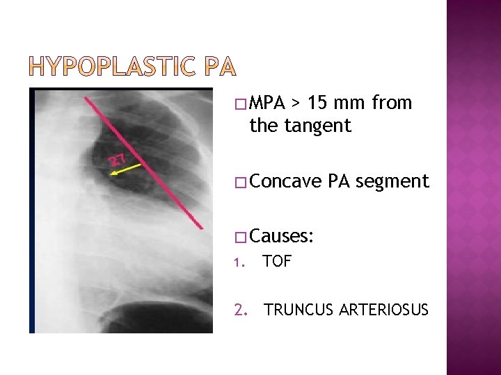 � MPA > 15 mm from the tangent � Concave PA segment � Causes: