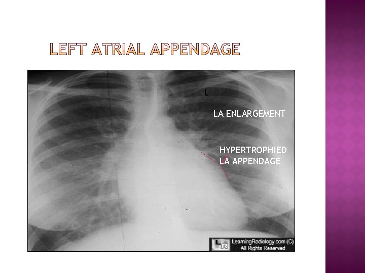 L LA ENLARGEMENT HYPERTROPHIED LA APPENDAGE 