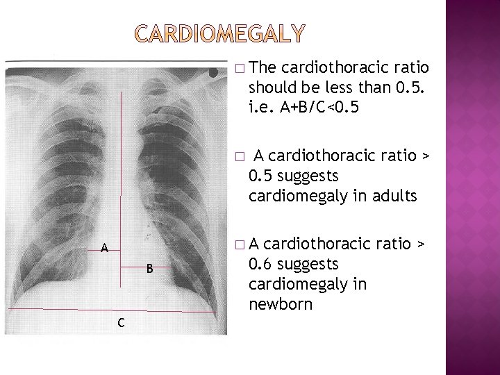 � The cardiothoracic ratio should be less than 0. 5. i. e. A+B/C<0. 5