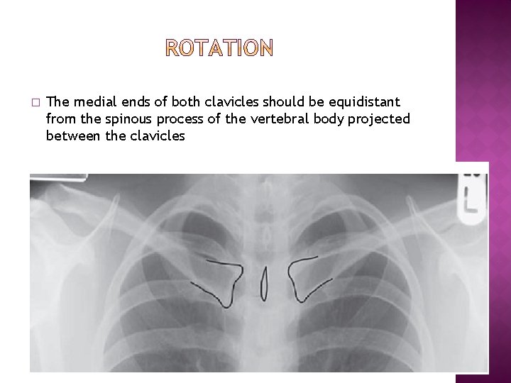 � The medial ends of both clavicles should be equidistant from the spinous process