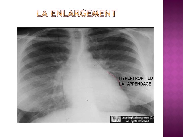 HYPERTROPHIED LA APPENDAGE 
