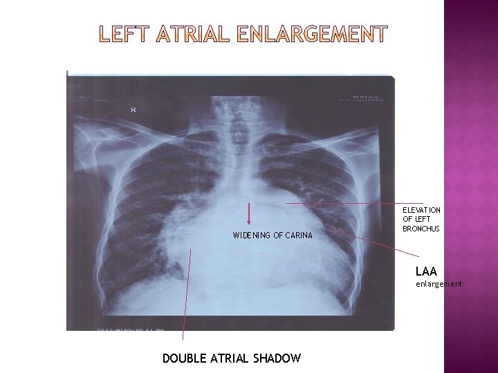 WIDENING OF CARINA ELEVATION OF LEFT BRONCHUS LAA enlargement DOUBLE ATRIAL SHADOW 