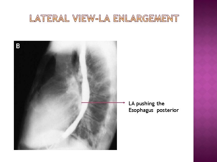 LA pushing the Esophagus posterior 
