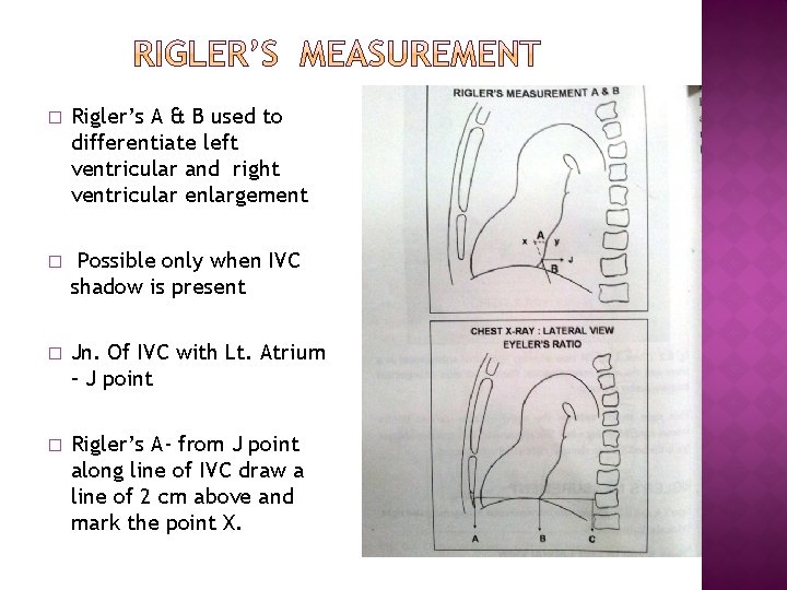 � Rigler’s A & B used to differentiate left ventricular and right ventricular enlargement