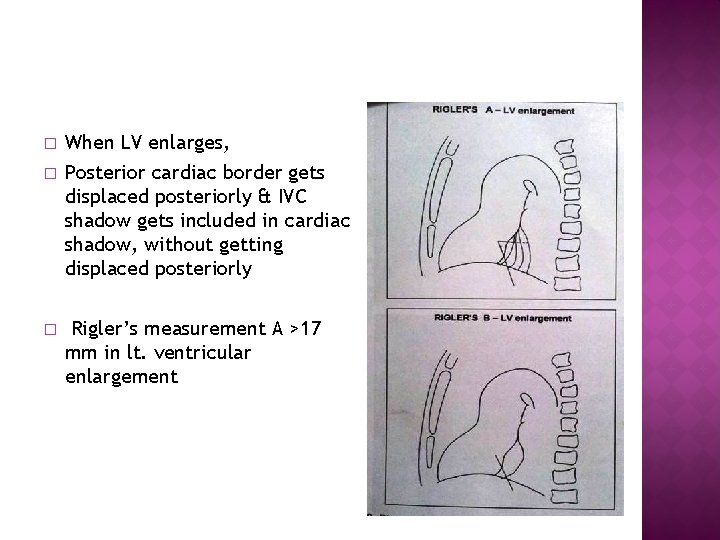 � � � When LV enlarges, Posterior cardiac border gets displaced posteriorly & IVC