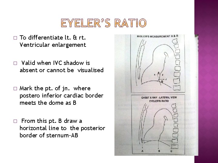 � To differentiate lt. & rt. Ventricular enlargement � Valid when IVC shadow is