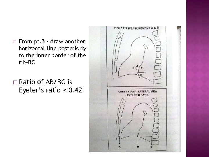 � From pt. B - draw another horizontal line posteriorly to the inner border