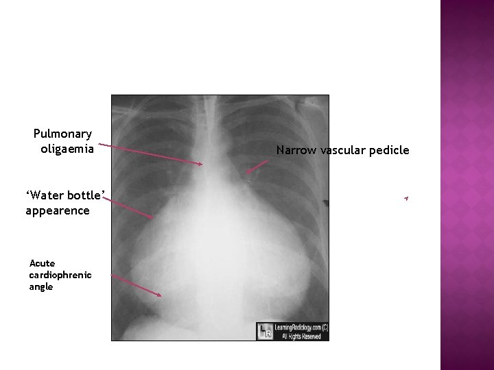 Pulmonary oligaemia ‘Water bottle’ appearence Acute cardiophrenic angle Narrow vascular pedicle 