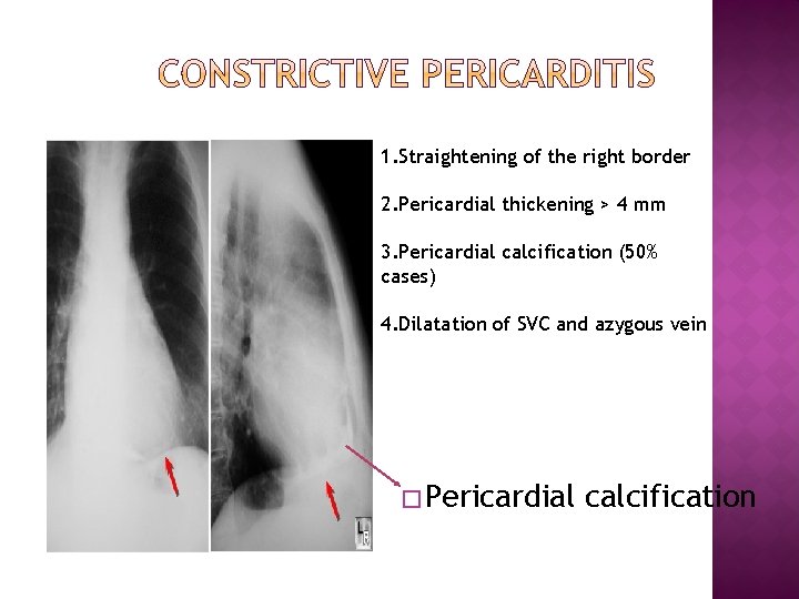 1. Straightening of the right border 2. Pericardial thickening > 4 mm 3. Pericardial