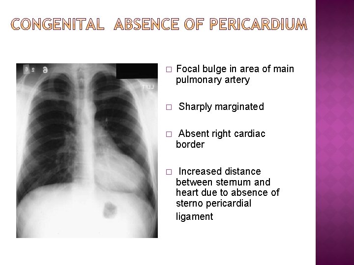 � Focal bulge in area of main pulmonary artery � Sharply marginated � Absent