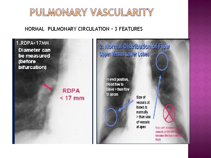 NORMAL PULMONARY CIRCULATION – 3 FEATURES 1. RDPA<17 MM 