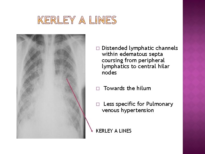 � � � Distended lymphatic channels within edematous septa coursing from peripheral lymphatics to