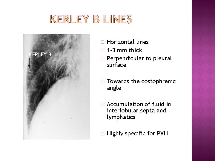 � KERLEY B � � Horizontal lines 1 -3 mm thick Perpendicular to pleural