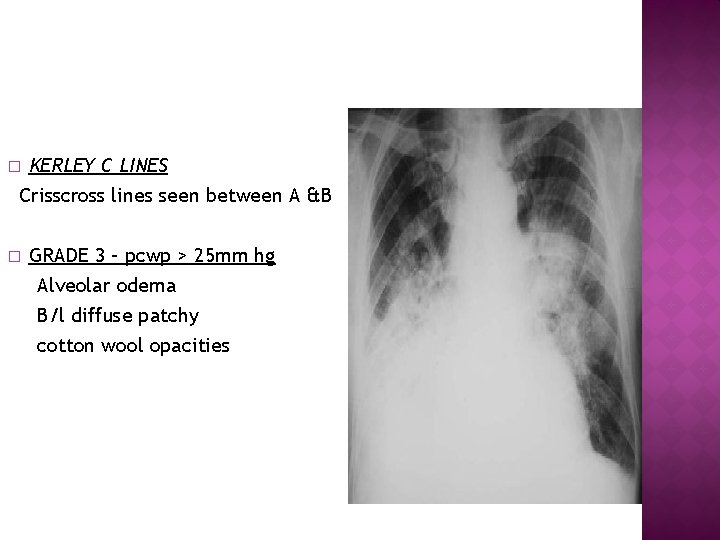 KERLEY C LINES Crisscross lines seen between A &B � � GRADE 3 –