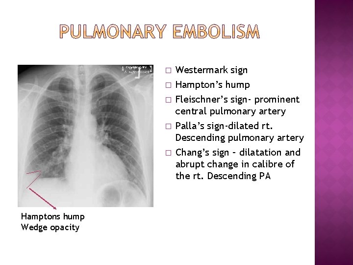 � � � Hamptons hump Wedge opacity Westermark sign Hampton’s hump Fleischner’s sign- prominent