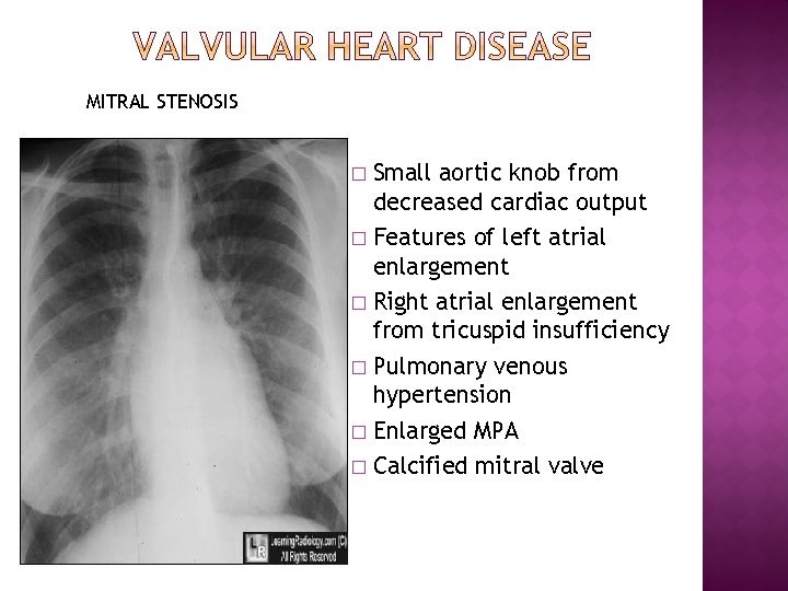 MITRAL STENOSIS Small aortic knob from decreased cardiac output � Features of left atrial