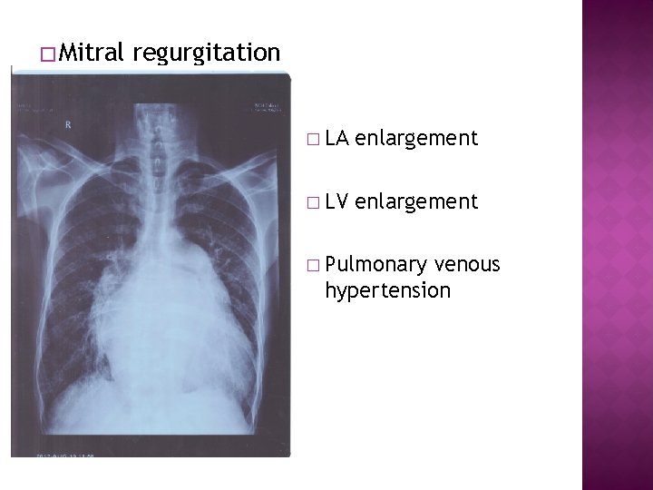 � Mitral regurgitation � LA enlargement � LV enlargement � Pulmonary venous hypertension 