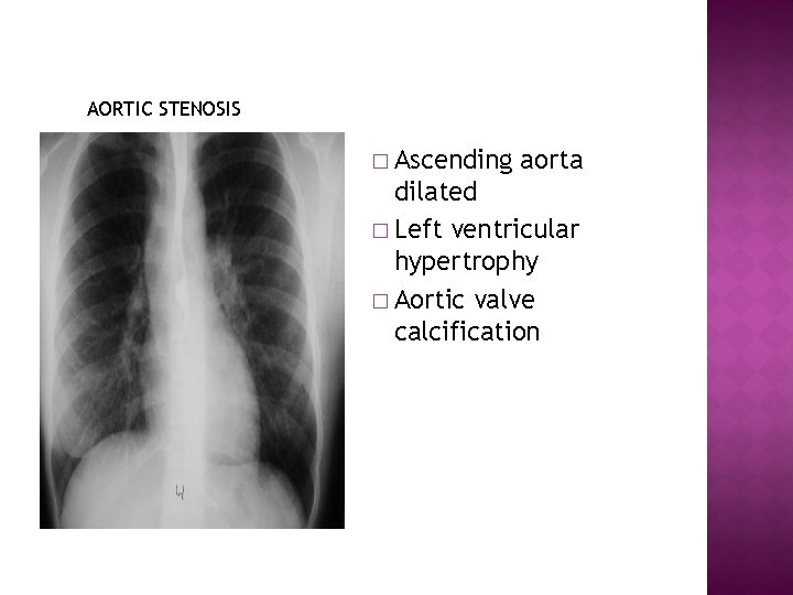 AORTIC STENOSIS � Ascending aorta dilated � Left ventricular hypertrophy � Aortic valve calcification
