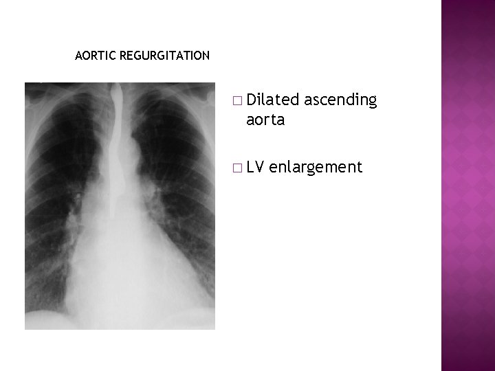 AORTIC REGURGITATION � Dilated ascending aorta � LV enlargement 