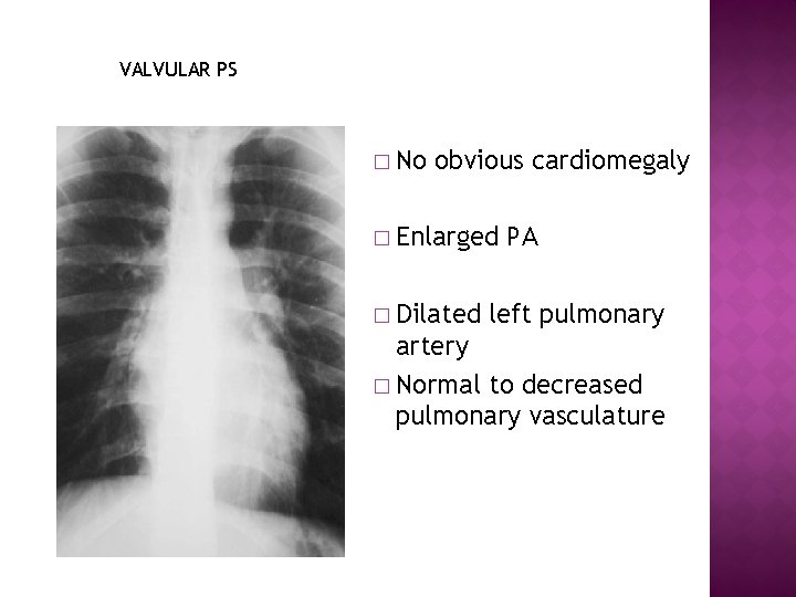 VALVULAR PS � No obvious cardiomegaly � Enlarged � Dilated PA left pulmonary artery