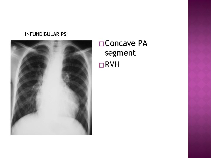 INFUNDIBULAR PS � Concave segment � RVH PA 